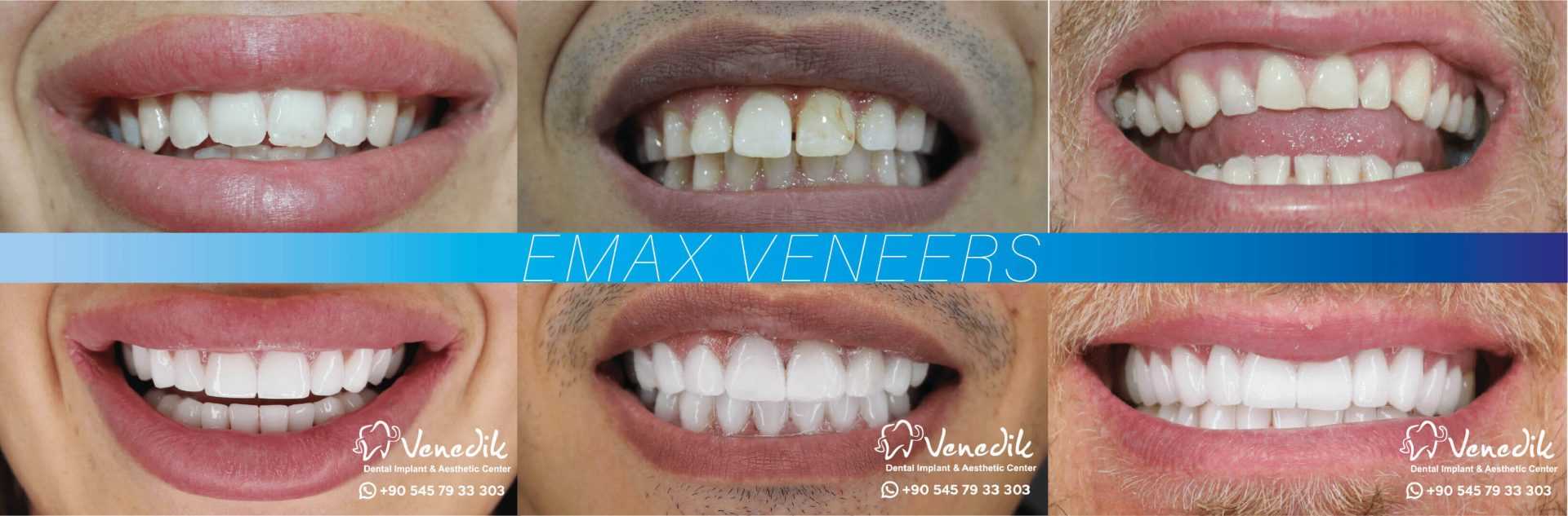 Dental Veneers In Turkey Venedik Dental Clinic In Turkey