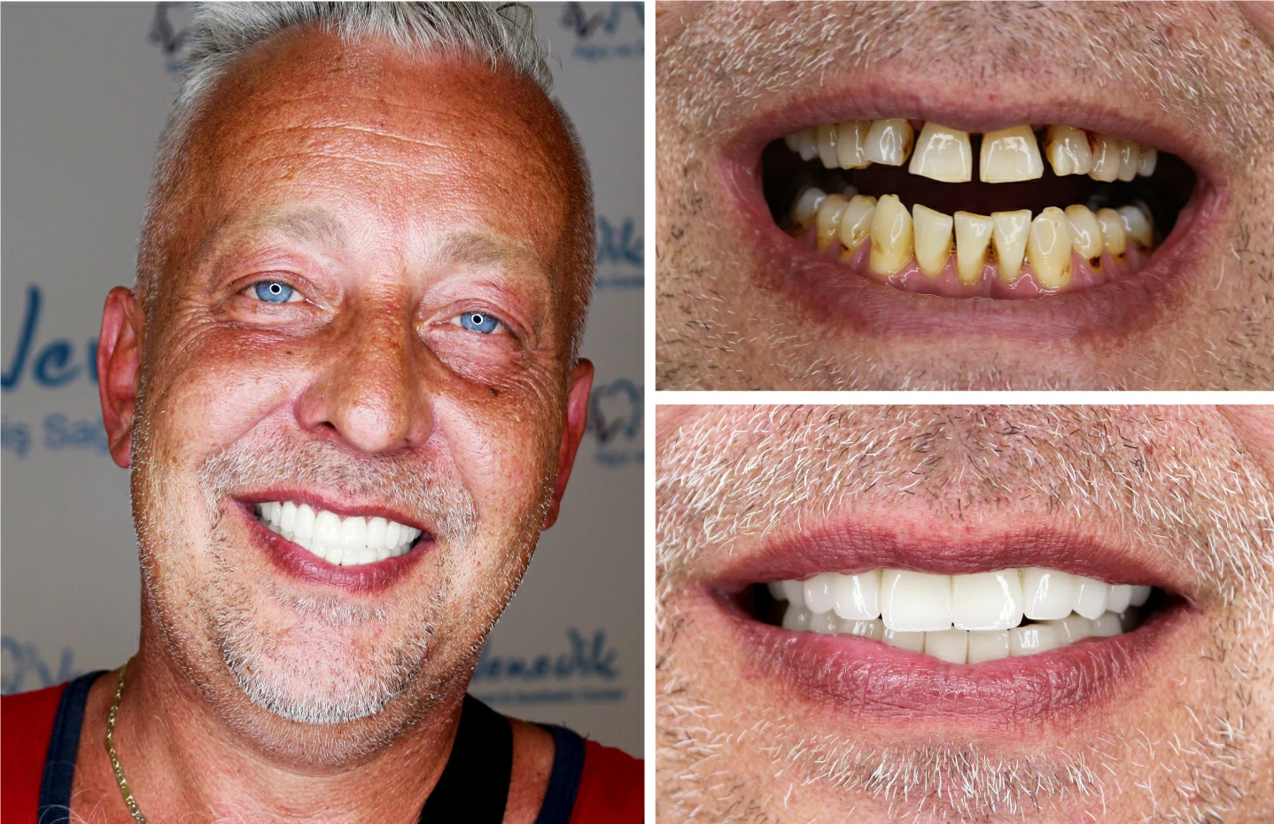 porcelain veneers turkey
